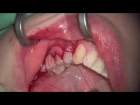 Bilaminar Flap in Periodontal Plastic Surgery with Connective Tissue
