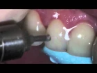 Removing Emax crown for endo.mov
