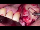 maxillary sinus lift membrane perfo repair by Achille Peivandi