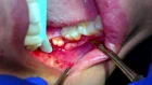 Extraction of wisdom teeth 1, 16, 17, 32 by Dr.Kambiz Sadraei