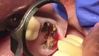 How to extract broken endodontic treated molar