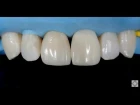 Эндодонтия и реставрация верхних резцов. Upper incisors endo & resto