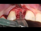 Implant Placement in Esthetic Zone (TRI NN 3.3mm/ 16mm) by Dr Sergio Spinato