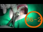 Extraction of upper wisdom tooth with forceps by Dr. Kim young sam 36-2