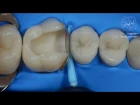 DentalПлюшки 11- адаптация матрицы
