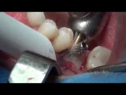 Immediate Implant placement in Lower molar area. By. Dr. Bechara