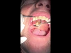 Palatal abscess curettage drainage of infected canine tooth - Dr Matt Tocuseanu @ Simi Dental Care