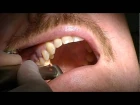 Extraction Tooth #4 - Severe Angulation of the root AND a fracture using Physics Forceps